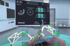 L&#039;interfaccia di STELLAR Knee che visualizza le dimensioni e le posizioni calcolate delle ossa della gamba durante l&#039;intervento al ginocchio. (Fonte: PolarisAR su Youtube)