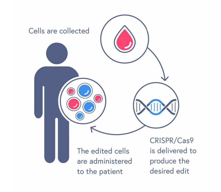 Il processo di trattamento CASGEVY prevede la trasfusione di cellule staminali del sangue modificate. (Fonte: CRISPR Therapeutics)