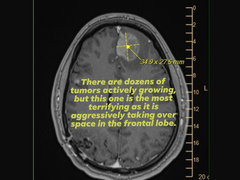 Una scansione della risonanza magnetica di Michael Prinke, caricata dalla moglie sui social media