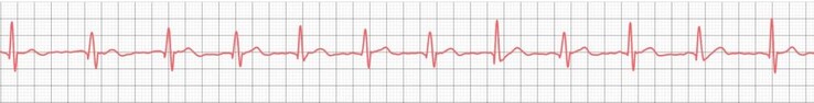 Anche gli smartwatch più economici hanno dimostrato di essere in grado di registrare correttamente ECG di base