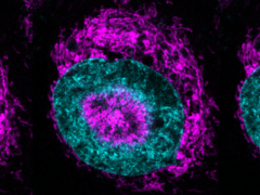 Una cellula tumorale confinata (nella foto) - i mitocondri di colore magenta possono essere visti accumularsi alla periferia nucleare di colore ciano e all'interno delle rientranze nucleari. (Fonte immagine/caption: Rito Ghose e Fabio Pezzano/Centro de Regulación Genómica)
