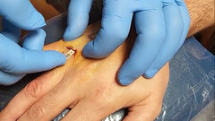 L'impianto di chiavi per auto Tesla può essere inserito attraverso una piccola incisione sulla pelle (immagine: Brandon Dalaly/Twitter)