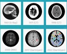 Il software medico AI BrainSee di Darmiyan può rilevare precocemente i segni dell'Alzheimer. (Fonte: Darmiyan)