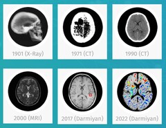 Il software medico AI BrainSee di Darmiyan può rilevare precocemente i segni dell'Alzheimer. (Fonte: Darmiyan)