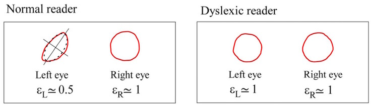 I centroidi di Maxwell differiscono per simmetria nei soggetti normali, ma sono simili nei soggetti dislessici. (Fonte immagine: DOI 10.3390/brainsci13101478)