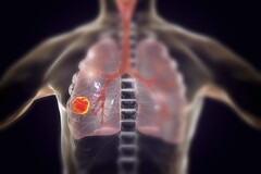 Solo nel 2022, 131.888 persone sono morte di cancro ai polmoni negli Stati Uniti. (Fonte immagine: KATERYNA KON/SCIENCE PHOTO LIBRARY/Getty Images)