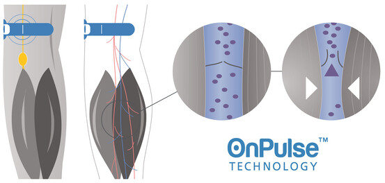 OnPulse (fonte: Sky Medical)